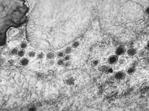 F,36y. | chemodectoma - neck